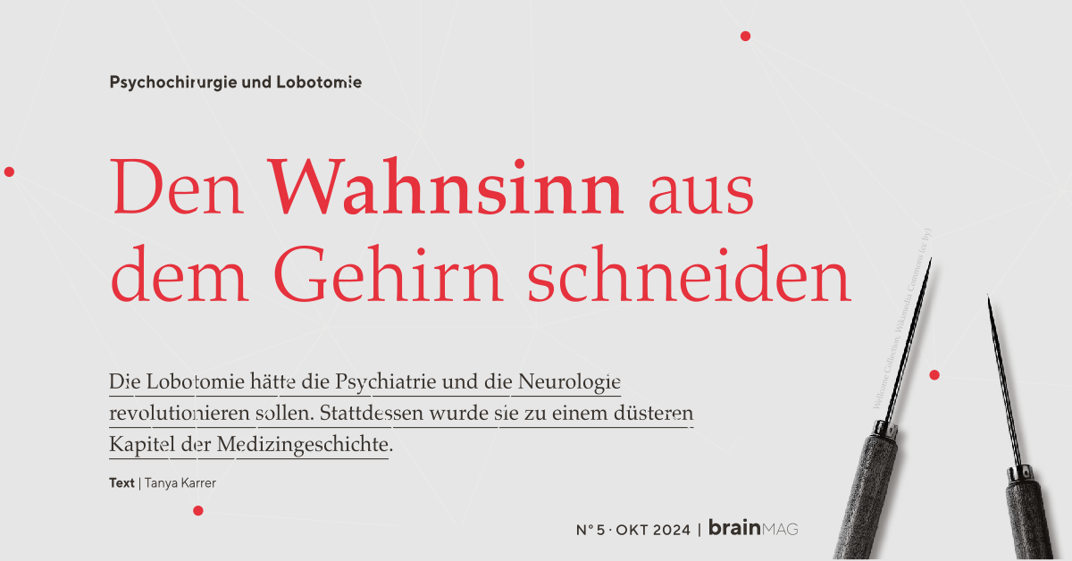 Psychochirurgie und Lobotomie: Den Wahnsinn aus dem Gehirn schneiden. Artikel für BrainMag von Tanya Karrer